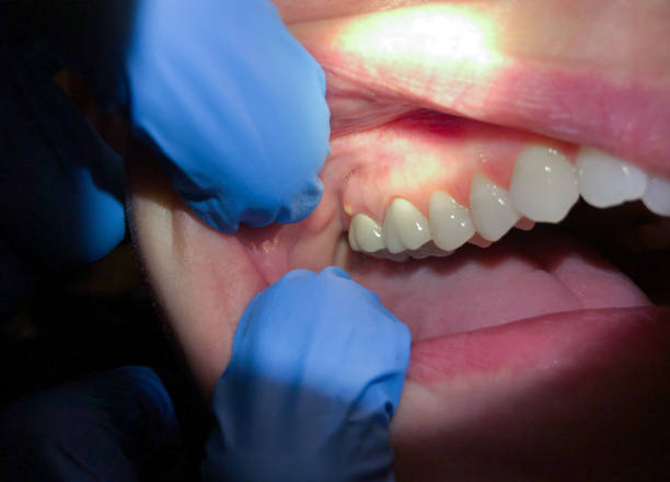 Best Emergency Dentist for Lost Fillings or Crowns in Arcade, GA